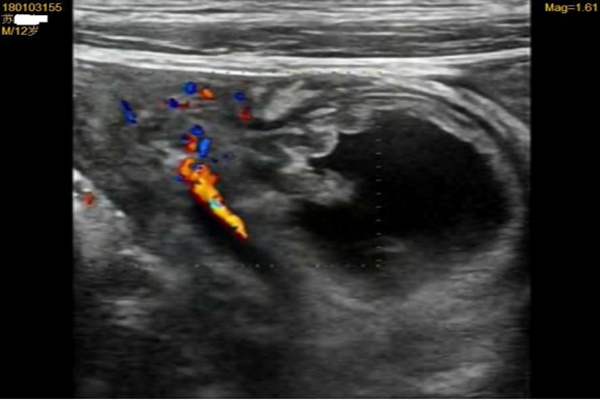附属武鸣医院超声诊断科成功诊断一例梅克尔憩室