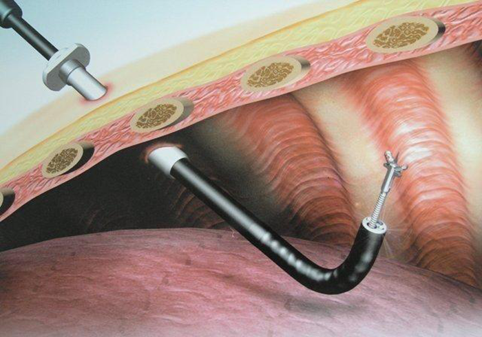 院于今年11月底引进先进的仪器--日本奥林巴斯cv290电子胸腔镜ltf-240